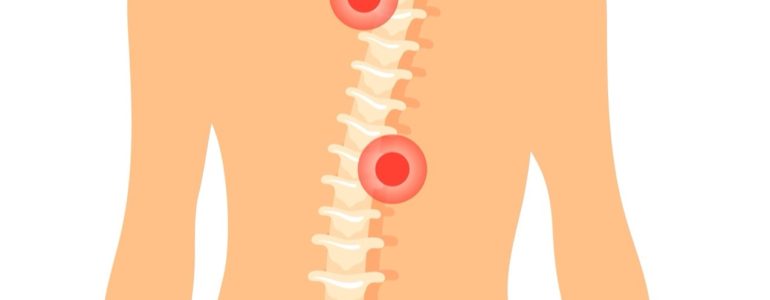 Vẹo Cột Sống - Nguyên Nhân Và Cách Khắc Phục Như Thế Nào?