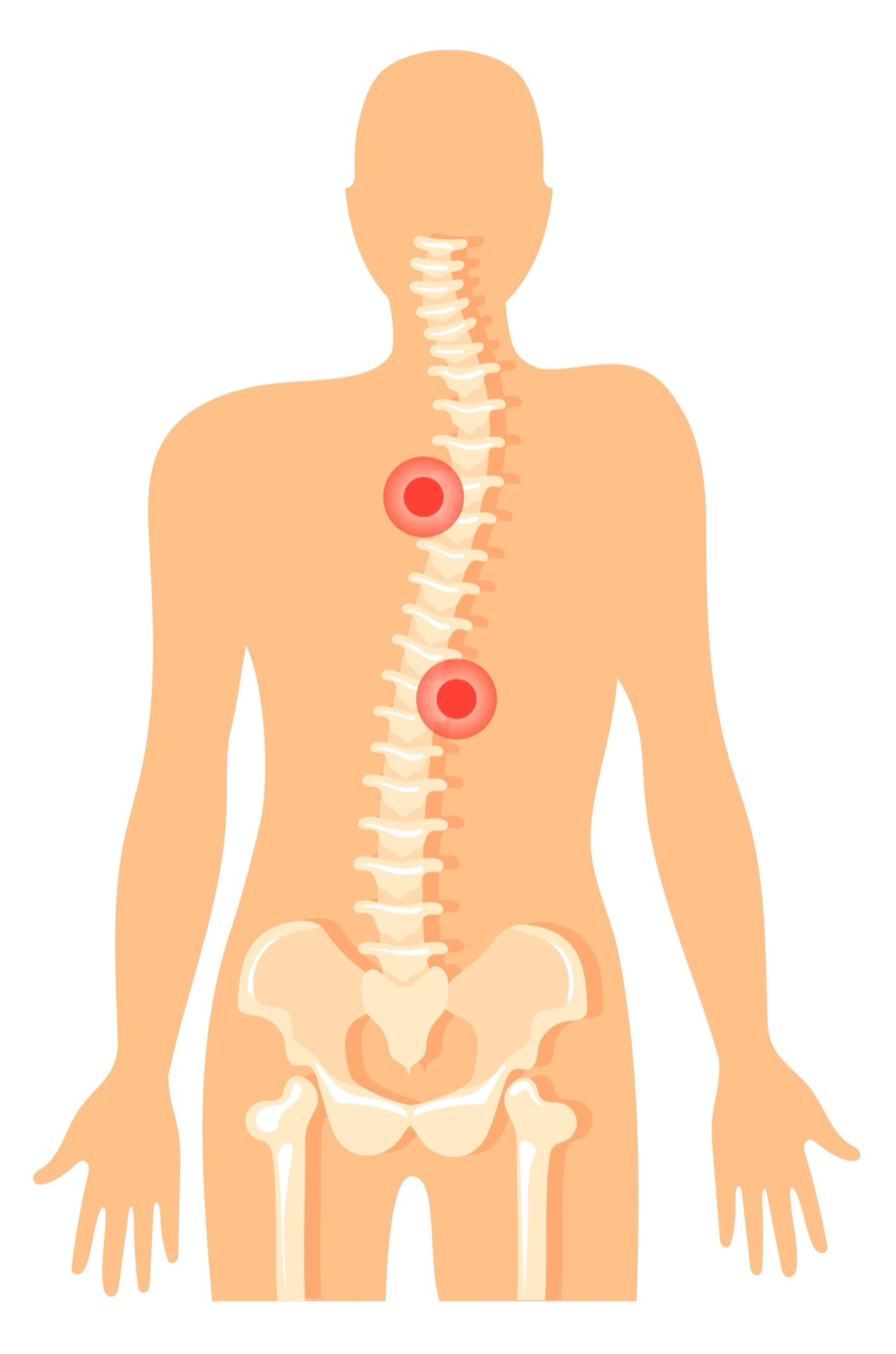 Vẹo Cột Sống - Nguyên Nhân Và Cách Khắc Phục Như Thế Nào?