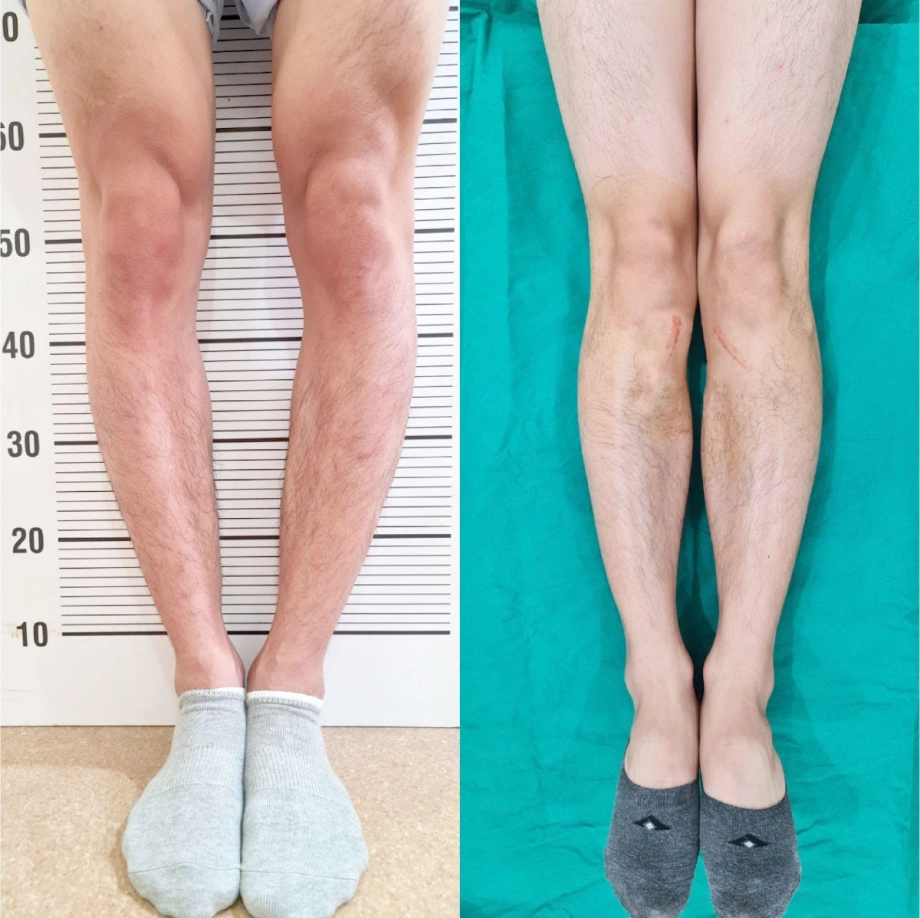 nguyên nhân bàn chân bẹt