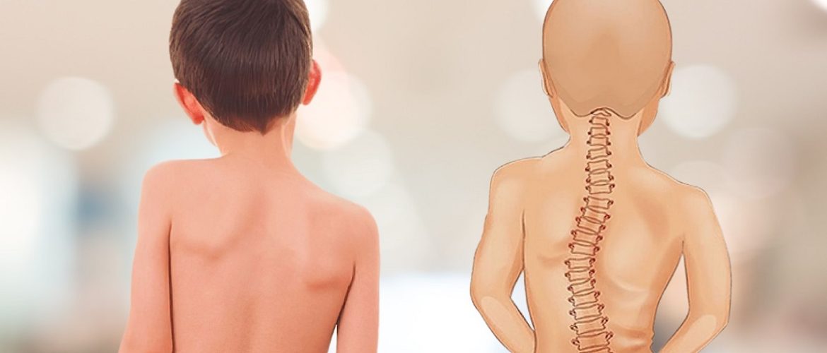 Dấu hiệu bất thường cột sống ở trẻ