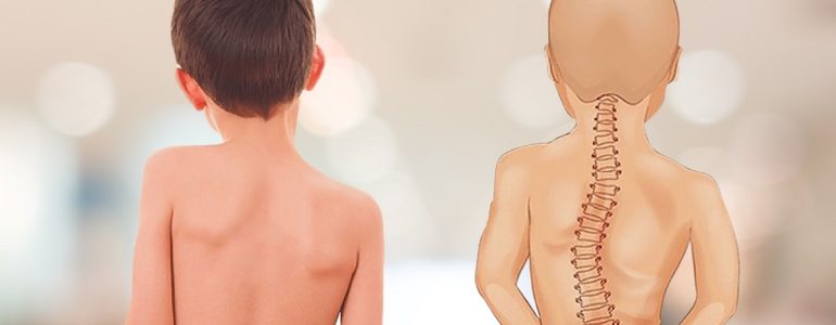 Dấu hiệu bất thường cột sống ở trẻ