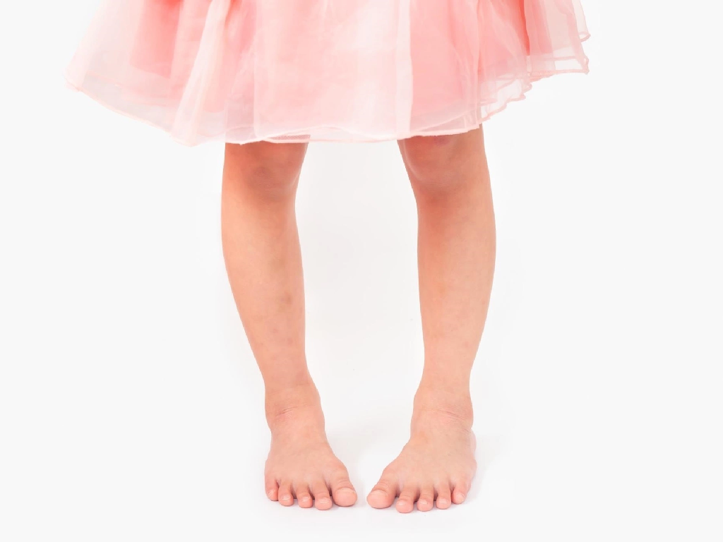 Vòng kiềng là tình trạng hai chân của trẻ bị cong