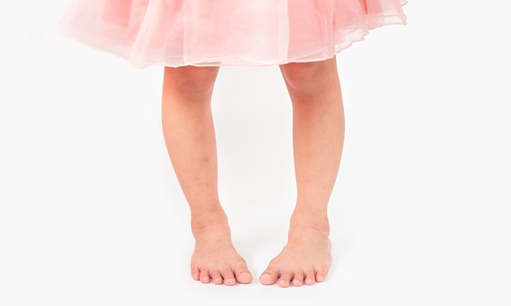 vòng kiềng nhẹ trẻ