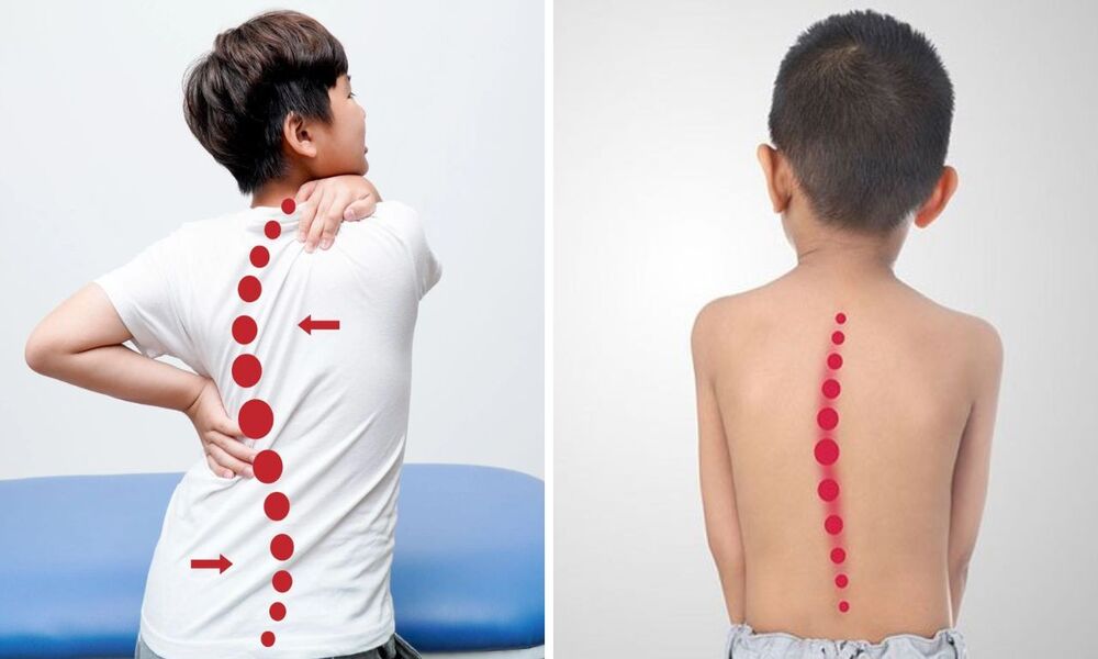 sàng lọc sớm vấn đề cột sống